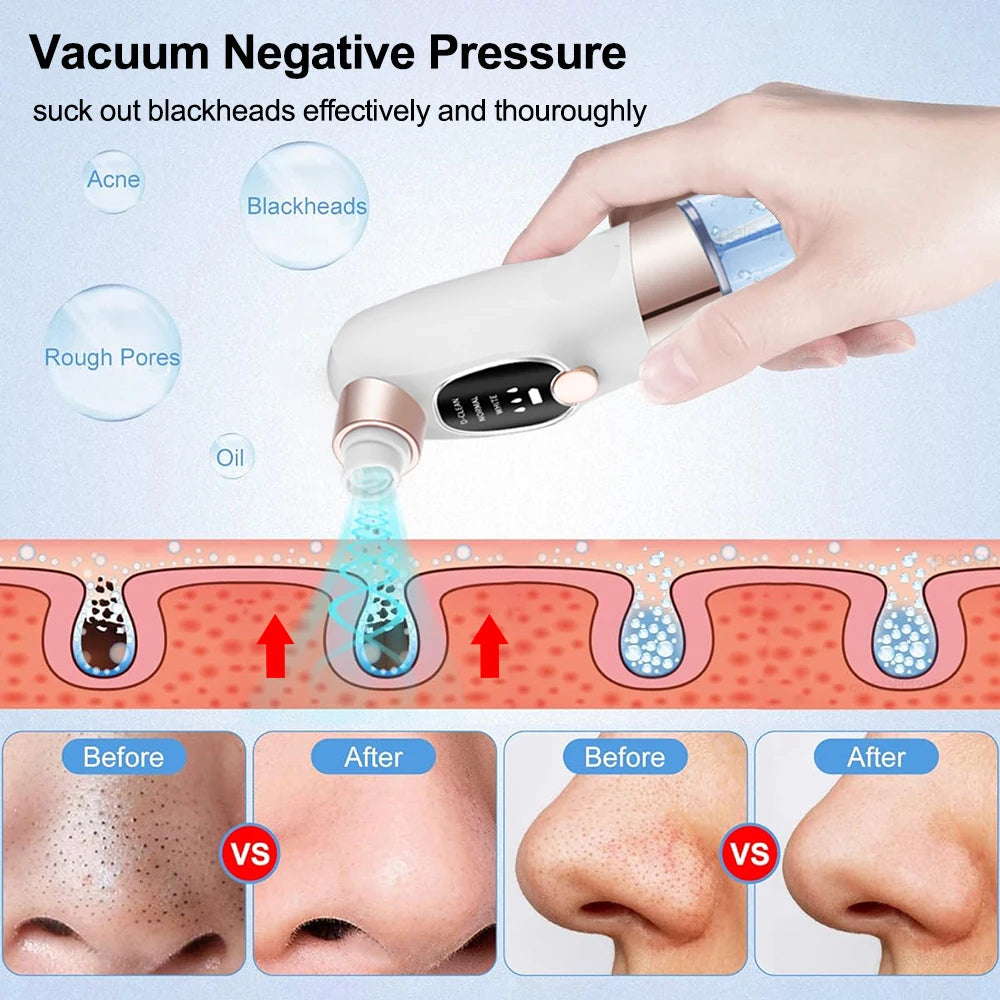 Vacuum device for blackhead removal with before and after effects on skin shown.